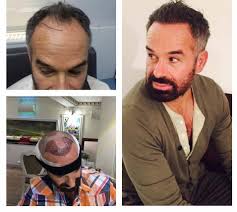Hair Transplantation Hair Transplant Best Hair Transplant Before After Hair