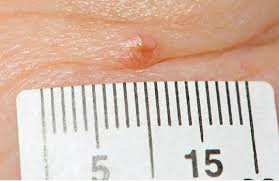 Review article synthesizes the latest science on melanoma screening and prevention. When To Suspect A Non Melanoma Skin Cancer The Bmj