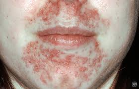Image result for red rash face