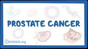 It's important to get checked if you have any of following problems. Prostate Cancer Physiopedia