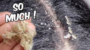 Like, ever tried wearing a black top while dealing with dandruff? My Best Flakes Ever Scalp Scratching And Picking Satisfying Dandruff Removal Asmr Youtube