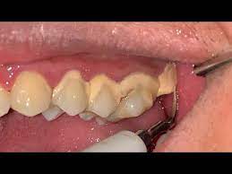 Karang Gigi Geraham Atas Dentist Dokter Gigi Tri Putra Youtube Dentist Hot Dog Buns Gigi