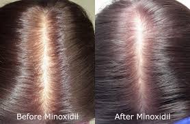 Men put it on their scalp in the front receding hairline area of in the back circle of hair loss. Can Rogaine Minoxidil Make Hair Loss Worse Limmer Htc