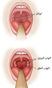 التهاب البلعوم تم التأكد من الإصابة ببكتريا ستريب