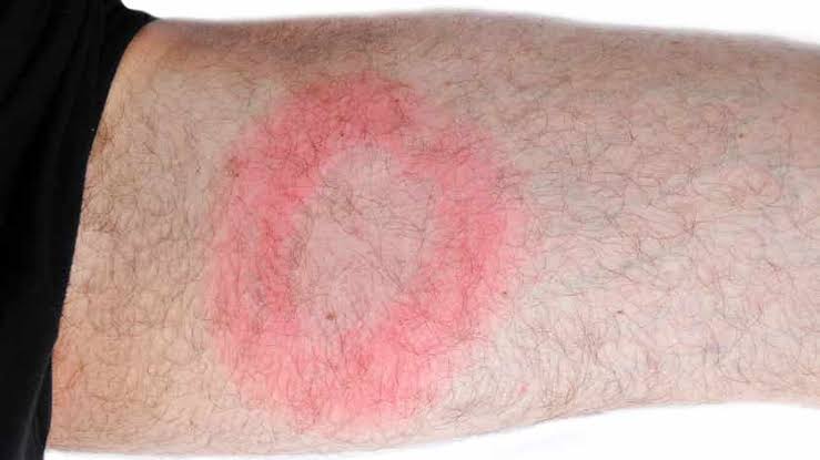 Borrelia: Vanliga symtom hos vuxna och barn