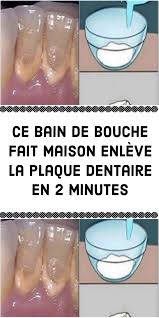 Ce Bain De Bouche Fait Maison Enleve La Plaque Dentaire En 2 Minutes Hygiene Bucco Dentaire Plaque Dentaire Dentaire