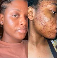 WHAT'S YOUR BIGGEST SKINCARE STRUGGLE ? 1.Dark spots 2.Dryness 3.Uneven  tone Identifying your skin struggle helps you pick the right skincare  routine and products. Fix those struggles with Ruddi 2000 lotion, Rich