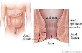 Fissure and fistula surgery