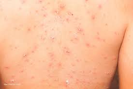 Bedak sejuk berubat ini diperkaya dengan calamine merah jambu dan herba rosemary, chamomilla recutica, glycyrhiza glabra dan ganoderma. Cara Menghilangkan Bekas Cacar Air Dengan Mudah Carevo