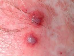The inflammationcauses bloodvessels in the skin, intestines, kidneys,. Henoch Schonlein Purpura Dermnet Nz