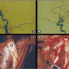 Artärbråck c, pulsåderbråck c, aneurysm c. Caso De Aneurisma Paraclinoideo Operado A Imagem Por Angiografia Download Scientific Diagram
