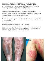 Protocole national de diagnostic et de soins (pnds) purpura thrombopenique immunologique de l enfant et de l adulte. Purpura Trombocitopenica Plaqueta Hematologia