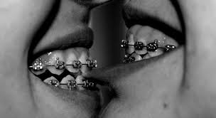 Black And White Braces Kissing Someone Without Braces Is Difficult Kissing Someone With Braces Is Impossible 19 Moments That Will Ma Braces Teeth Colors Braces Girls Braces Smile