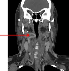 The main ones draining these two regions are the Tortuous Internal Carotid Artery An Important Differential Of The Pulsatile Oropharyngeal Mass Bmj Case Reports