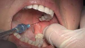 As the anesthetic wears off after the removal, you may feel some discomfort, but it is unlikely that you will feel pain. How To Give Local Anesthesia For Dental Professionals Youtube