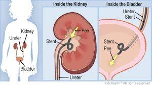 Ureteral Stent Dayton Children S