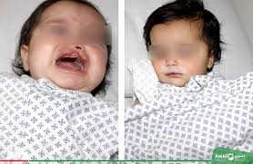 د دوهم ځل لپاره یو شمیر ماشومانو ته د کام چاک او لب چاک (د شونډو د چاک او  تالو لویدلي) وړیا عملیات ترسره شوه. د عبدالمنان امیري خیریه بنسټ په مرسته