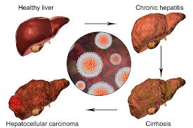 Different types of cancer have different rates of survival in stage 4. Stage 4 Bladder Cancer Treatment Onco Com