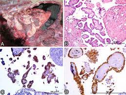 A mesothelioma diagnosis can leave anyone reeling. Scielo Brasil Fatal Hemothorax Caused By Pleural Mesothelioma In A Lion Fatal Hemothorax Caused By Pleural Mesothelioma In A Lion