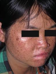 Disorders of Pigmentation