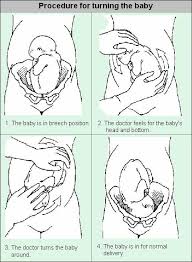 In particular, concise code including deflation can be developed. What Is Ecv External Cephalic Version External Cephalic Version Breech Babies Turn A Breech Baby