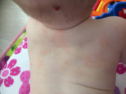 Image result for vyrážka u dětí