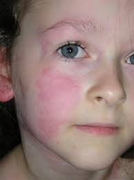 Natural Home Remedy For Hives New Life On A Homestead Home Remedies For Hives Hives Remedies Natural Cough Remedies
