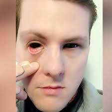 Vincent Muskel Berg tatuerade ögonvitorna