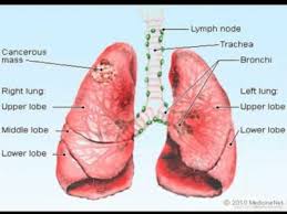 Together you can decide whether lung cancer screening is right for you. Lung Cancer Archives Canceris