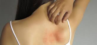Image result for sweat rash on back