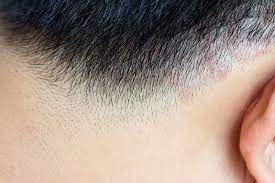 Tinea versicolor may improve a little in cool or dry weather, but it usually doesn't go. Kann Haarausfall Durch Kleienpilzflechte Ausgelost Werden