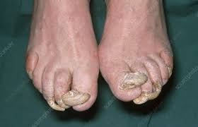 Image result for Onychogryphosis feet