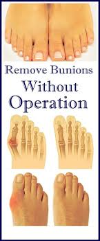 What Is Exactly Bunion Many People Means That Bunion Is A Bone But Bunion Actually Is Salt Deposits That Becom Bunion Remedies Bunion Cure Bunion Treatment