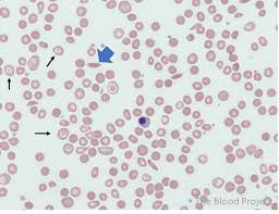 Image result for Peripheral Smear