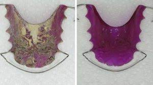 Combine equal parts of water and vinegar in a bowl or dish. Q What Is The White Buildup On My Retainer Dental Image Therapy Centres
