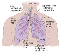 Lung Carcinoid Tumor Stages