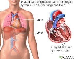 Image result for Cardiomyopathy