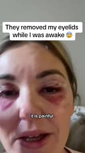 Eyelid Reduction Surgery Recovery: Pain, Swelling, and Healing Process