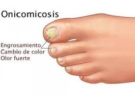 Hongos uña dedo gordo pie. Onicomicosis Cuando Los Hongos Estan En Las Unas Mejor Con Salud