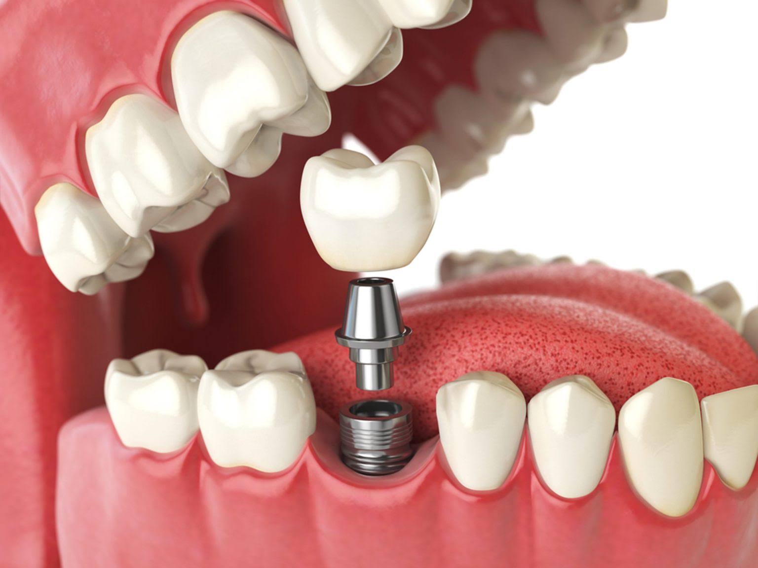 Dental Implants product image