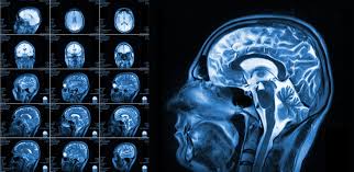 Brain MRI Imaging in Dallas, TX | Southwest Diagnostic Imaging Center