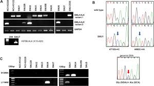 Though we commonly think of lung cancer as a disease that affects tobacco smokers, it can affect anyone. Heterogeneity Of Genetic Changes Associated With Acquired Crizotinib Resistance In Alk Rearranged Lung Cancer Journal Of Thoracic Oncology