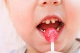 Milchzahn Ziehen Wann Ist Es Bei Kindern Erforderlich