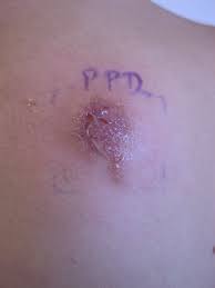 Последние твиты от ppd test (@ppdtest). Blistered Positive Patch Test Reaction On Day 4 To 1 Ppd Download Scientific Diagram