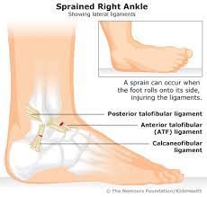 How to tell if your ankle is sprained. Ankle Sprains For Teens Nemours Kidshealth