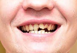 Broken Teeth Treatment In Dublin Portobello Dental Clinic