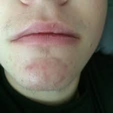 With that increase in facial hair, an individual taking testosterone may also end up with ingrown hairs and folliculitis, dr. How Long Would It Take To Get A Full Beard From T