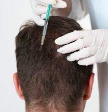افضل دكتور لعلاج فراغات الشعر بالرياض أشطر 7 أطباء معروف maarof