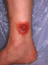 Image result for wolf spider bite skin