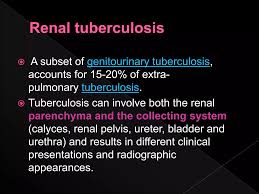 Image result for Genitourinary Tuberculosis